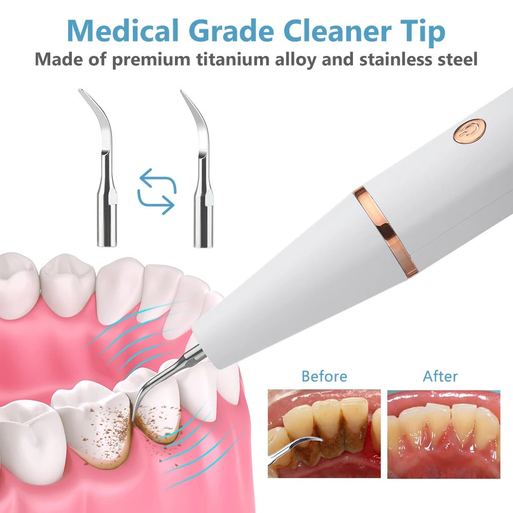 Close-up of home ultrasonic dental tool, showing professional tip for effective plaque and tartar removal.