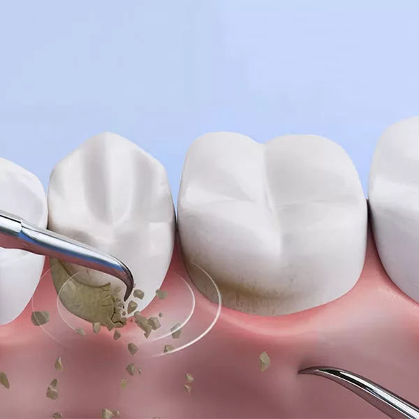 Rechargeable ultrasonic dental calculus remover. Effectively removes plaque & tartar for a deep clean & healthier gums.
