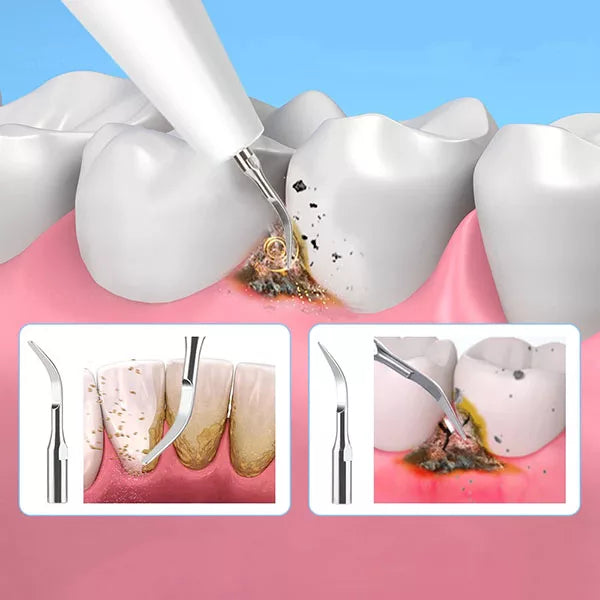 Ultrasonic teeth cleaner & plaque remover for effective tartar removal. Home dental care tool for a brighter, healthier smile.